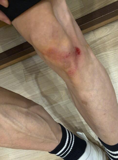 心疼张一山运动摔伤腿晒照自嘲上了年纪