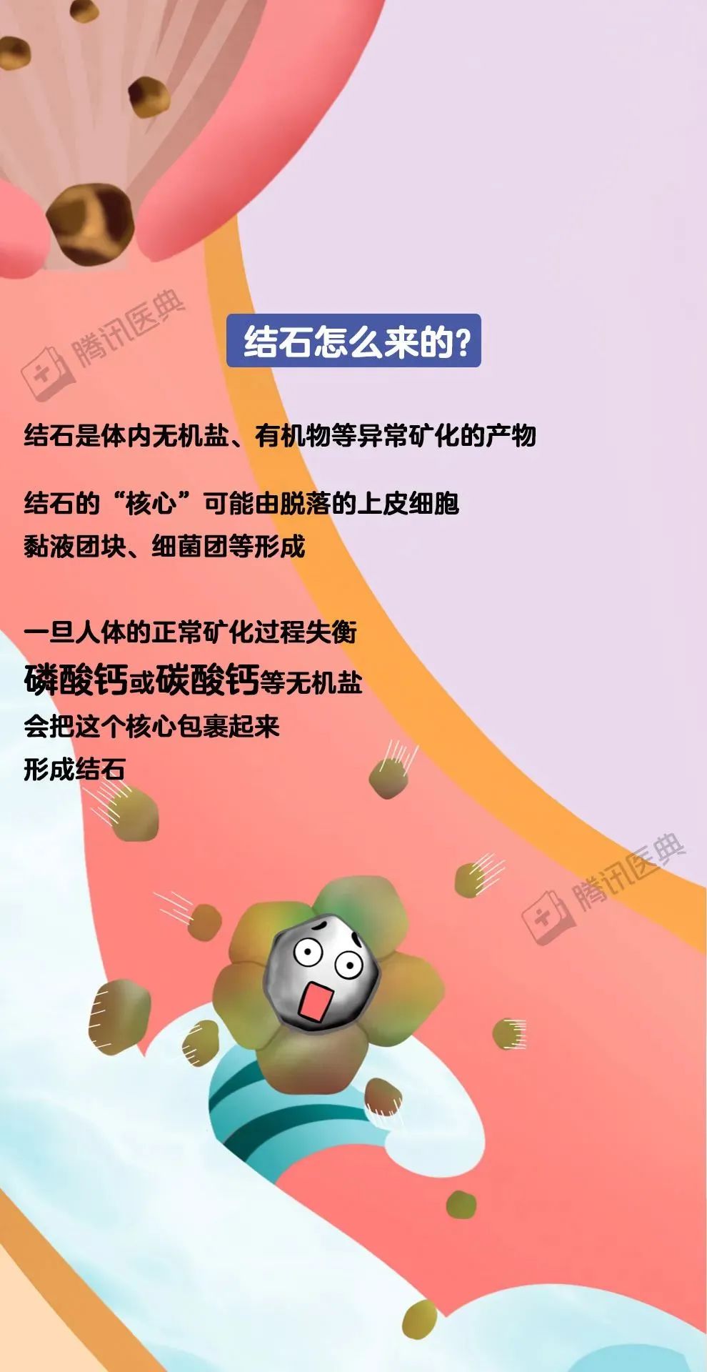 唾液腺,膀胱,尿道这些"小众"地方也可能会长石头比如,涎石是唾液腺里