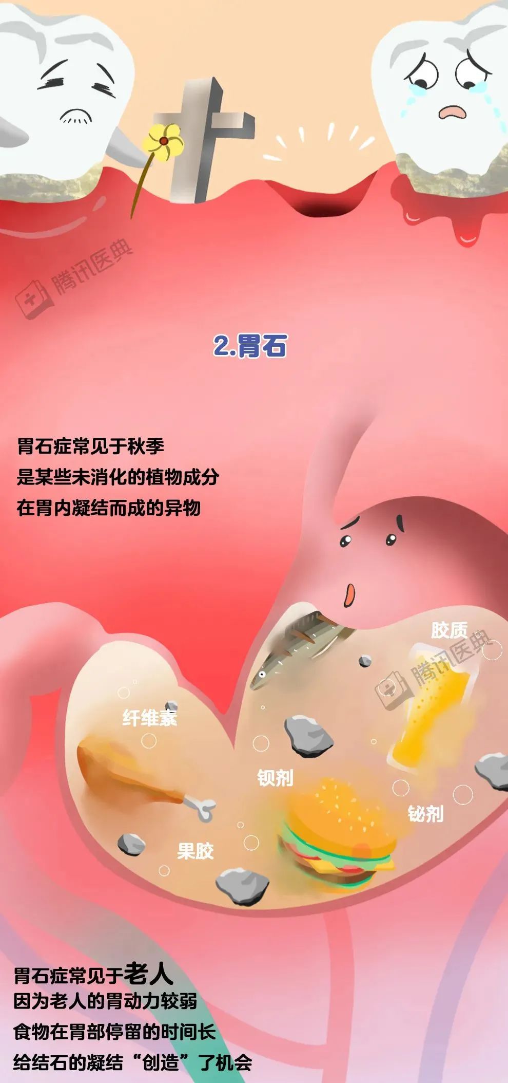 结石形成过程大揭秘!__财经头条