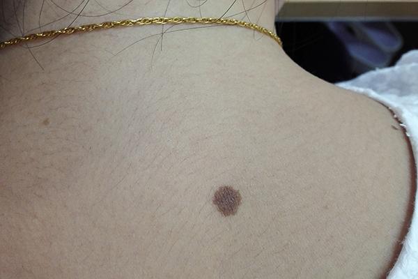 痣有好有坏,长在哪里,什么样的痣可能是坏痣?提醒:别用手抠