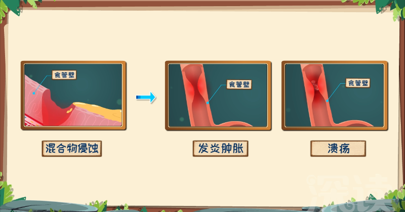胃食管反流咋回事？反酸烧心背后真相是啥？胃食管反流发病机制动漫版！_新浪新闻