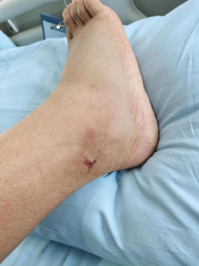 天气转热小心蛇出没深圳大叔被毒蛇咬伤右脚踝