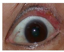 及睑结膜面黄白色隆起皮脂腺癌发病率在我国眼睑恶性肿瘤中排第二位