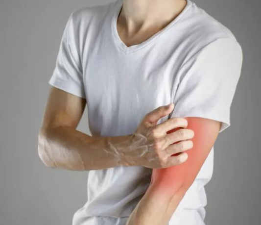 夏季皮肤瘙痒怎么办? 专家:不要盲目听信"偏方"