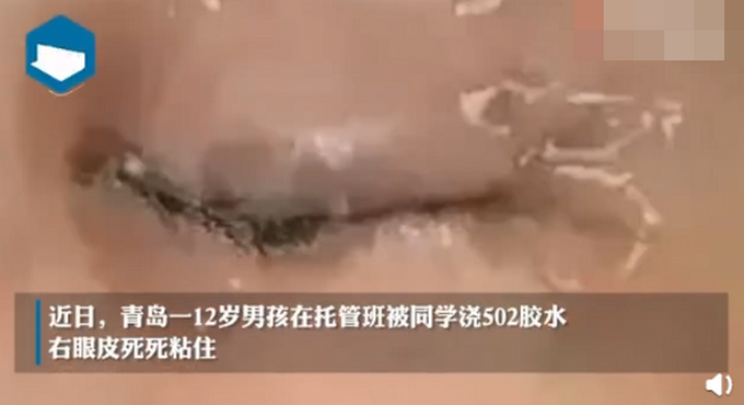 青岛12岁男孩被托管班同学浇502胶水，右眼皮死死粘住！网友怒了休闲区蓝鸢梦想 - Www.slyday.coM