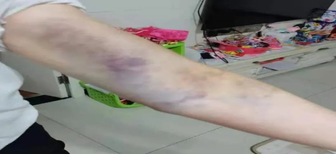 经诊断,李奶奶的手臂软组织挫伤,并未伤及骨头.