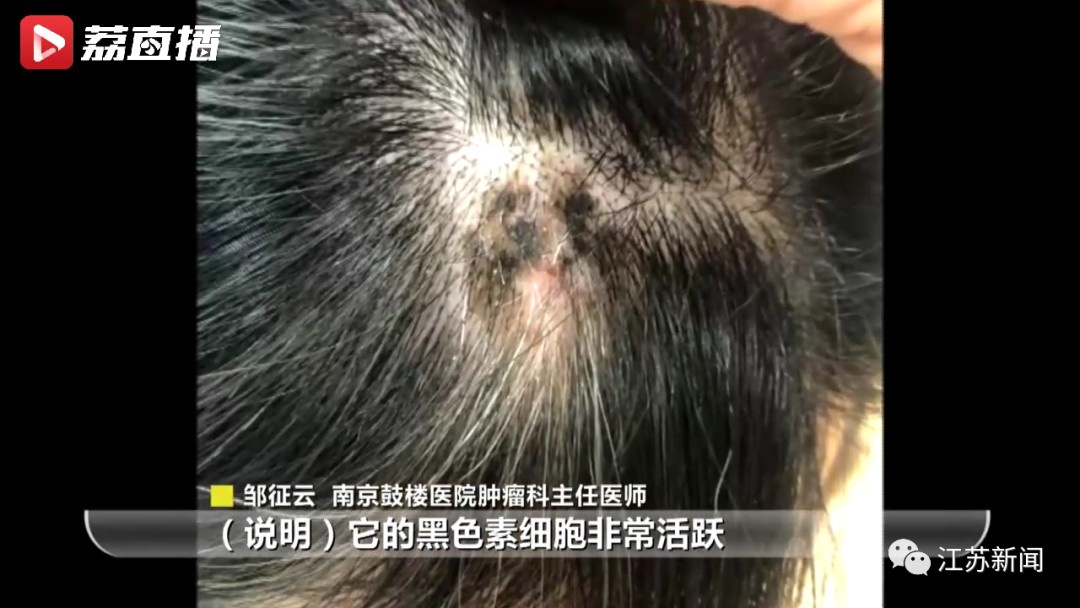 头皮小黑斑,竟能致命!医生提醒:这些人要注意|黑色素瘤_新浪新闻