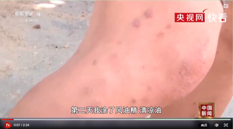 市民被红火蚁咬伤后，皮肤受伤严重  图自央视网视频截图