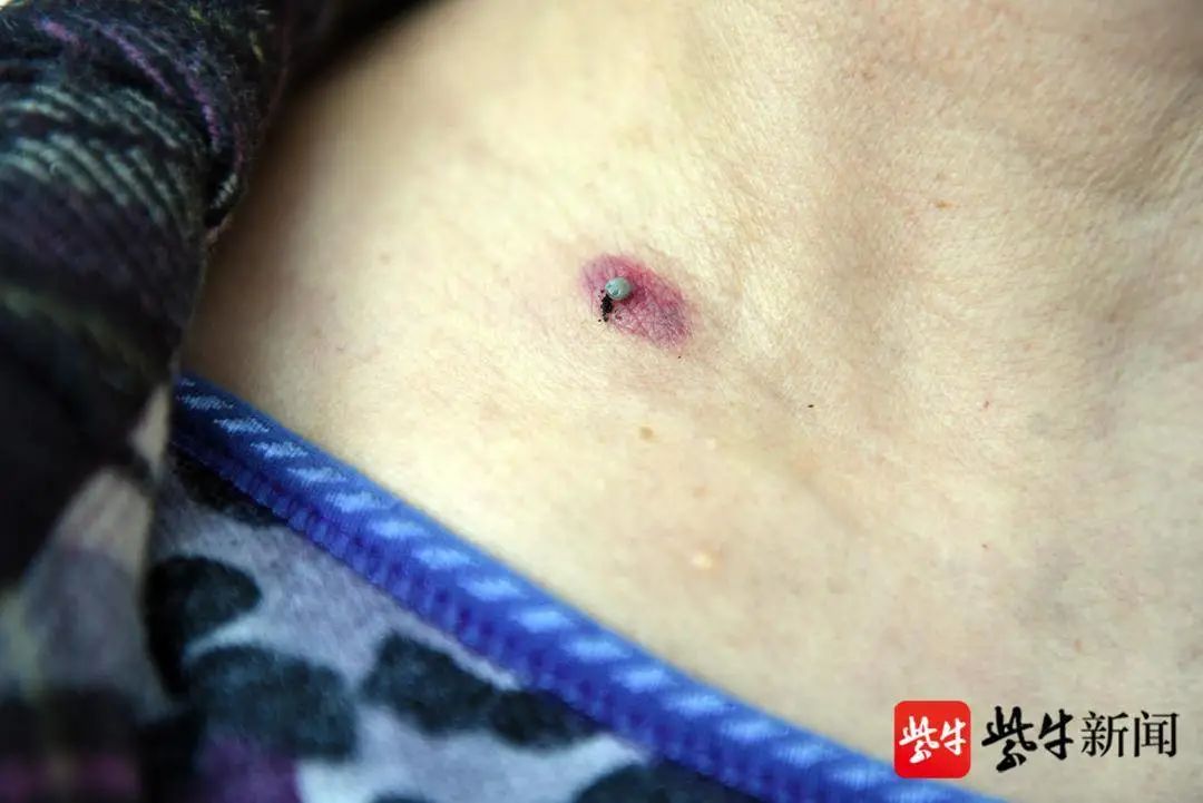 李女士到某医院就诊后,医生诊断为蜱虫咬伤,但因缺