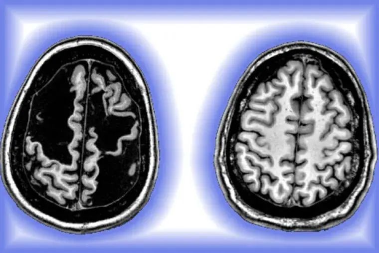 丹尼尔（左）和尼科博士（右）的大脑影像。丹尼尔大脑影像的暗区反映了左右大脑半球大量组织缺失