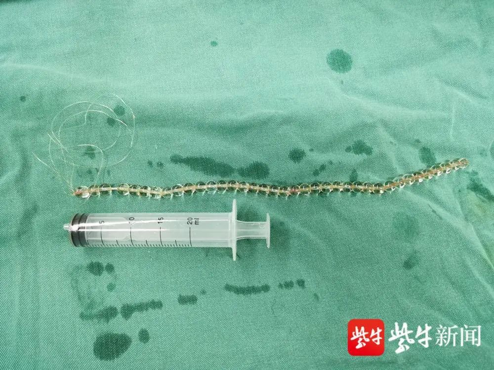 小伙膀胱里有串项链自己塞的