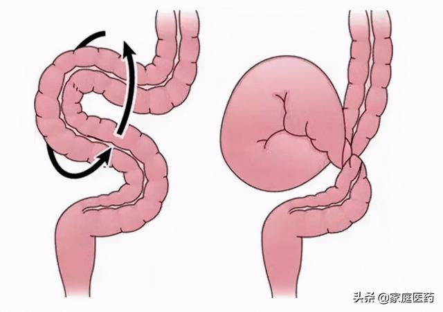 乙状结肠扭转又是肠梗阻的常见原因