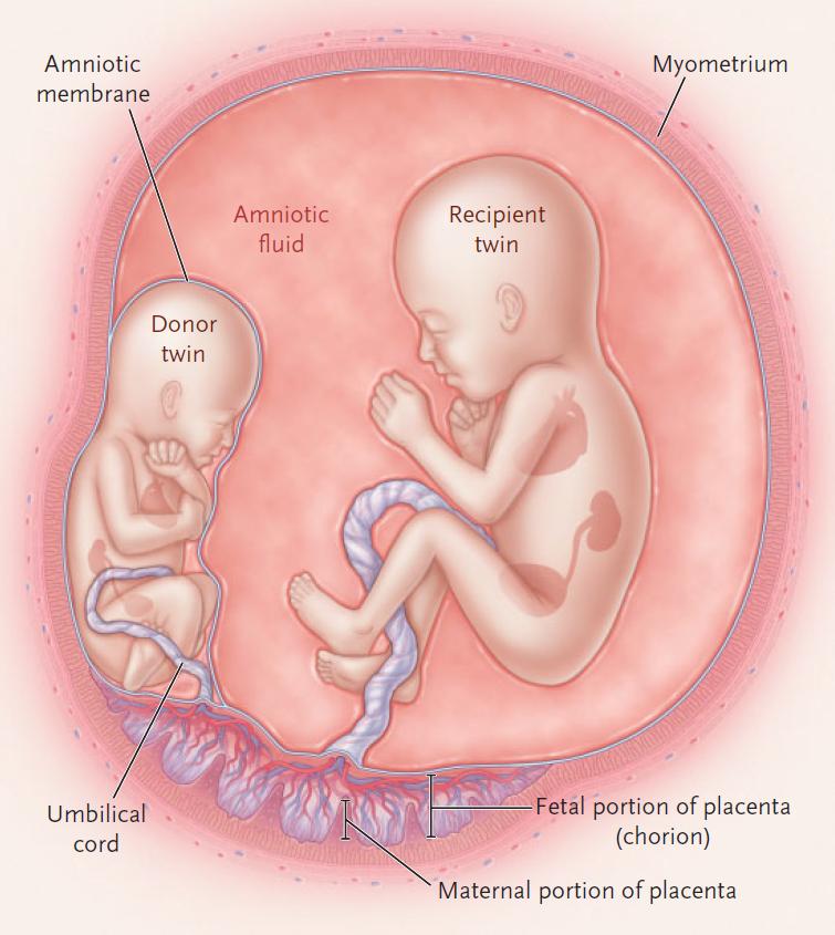 正文  这是单绒毛双羊膜囊单卵双胞胎的一种比较严重的并发症.