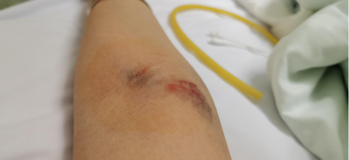 从不舒服到确诊为急性淋巴细胞白血病,我只用了17天