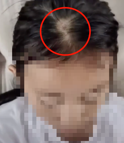 10天不到女孩头顶竟然秃了做这事千万慎重