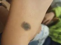 医用皮肤镜什么牌子好85岁李大爷脖子后长颗“小痣”竟是癌！专家提醒：这类痣要当心！_https://www.jmylbn.com_新闻资讯_第2张