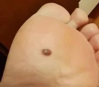 医用皮肤镜什么牌子好85岁李大爷脖子后长颗“小痣”竟是癌！专家提醒：这类痣要当心！_https://www.jmylbn.com_新闻资讯_第5张