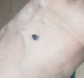 医生建议:建议来皮肤镜检查女,37岁,左脚脚背六七年前长了一颗痣,短