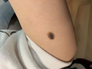 医用皮肤镜什么牌子好85岁李大爷脖子后长颗“小痣”竟是癌！专家提醒：这类痣要当心！_https://www.jmylbn.com_新闻资讯_第6张