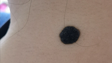 医用皮肤镜什么牌子好85岁李大爷脖子后长颗“小痣”竟是癌！专家提醒：这类痣要当心！_https://www.jmylbn.com_新闻资讯_第8张