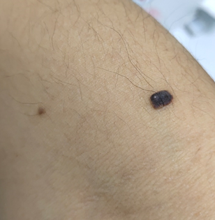 医用皮肤镜什么牌子好85岁李大爷脖子后长颗“小痣”竟是癌！专家提醒：这类痣要当心！_https://www.jmylbn.com_新闻资讯_第4张