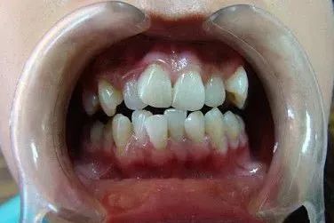 第三届东莞口福行动免费领种植牙