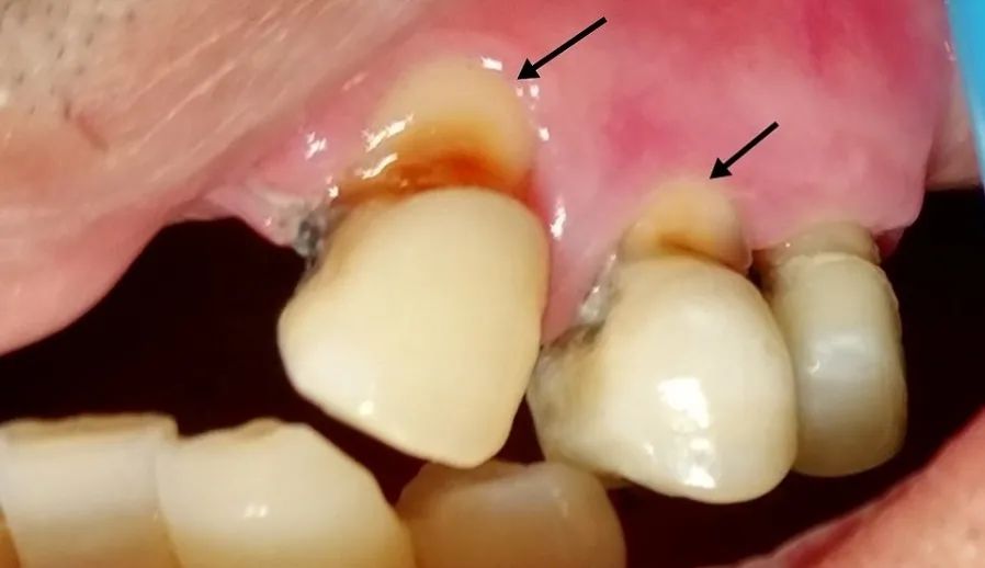 1个刷牙坏习惯可能毁了半口牙,但你却天天都在做|牙线|牙齿|刷牙_新浪