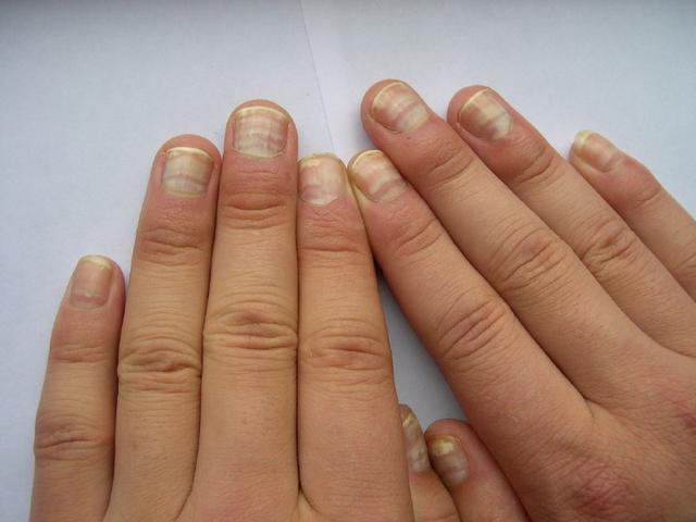 肝脏越不健康下面的症状可能会越明显