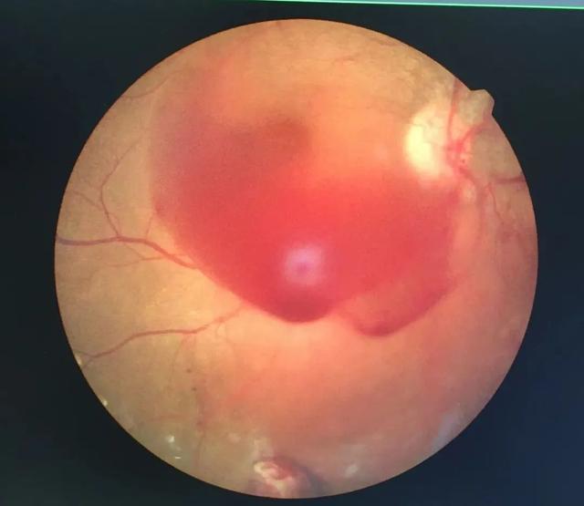 发现小婷的情况确实更严重了:右眼玻璃体积血合并牵拉性视网膜脱离