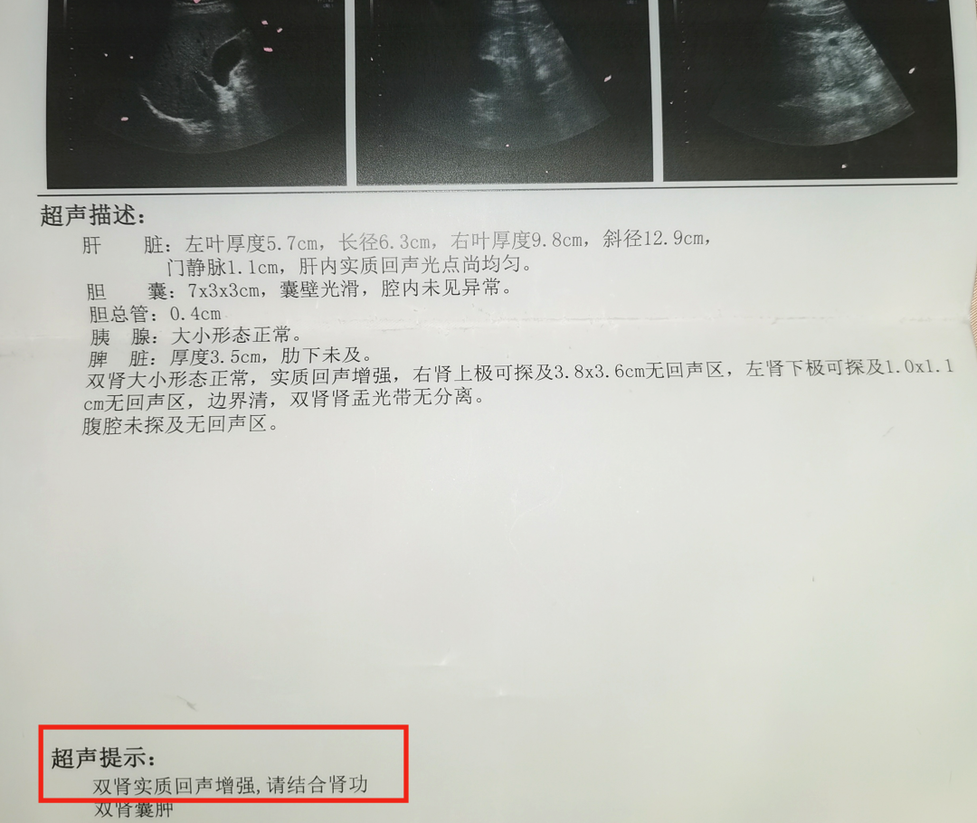 问康复师:肾友超声报告「肾实质回声增强」,什么意思?要紧吗?