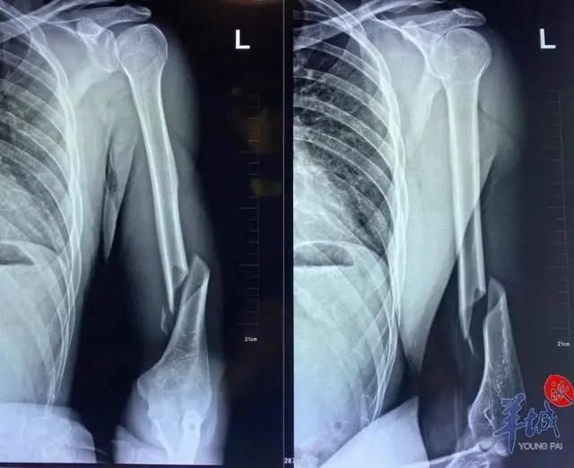 28岁小伙掰手腕,结果胳膊断了|胳膊|骨折_新浪新闻