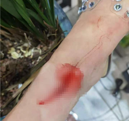 伤口很深李雪洁说,事后自己去诊所进行了包扎处理目前已无大碍"当时