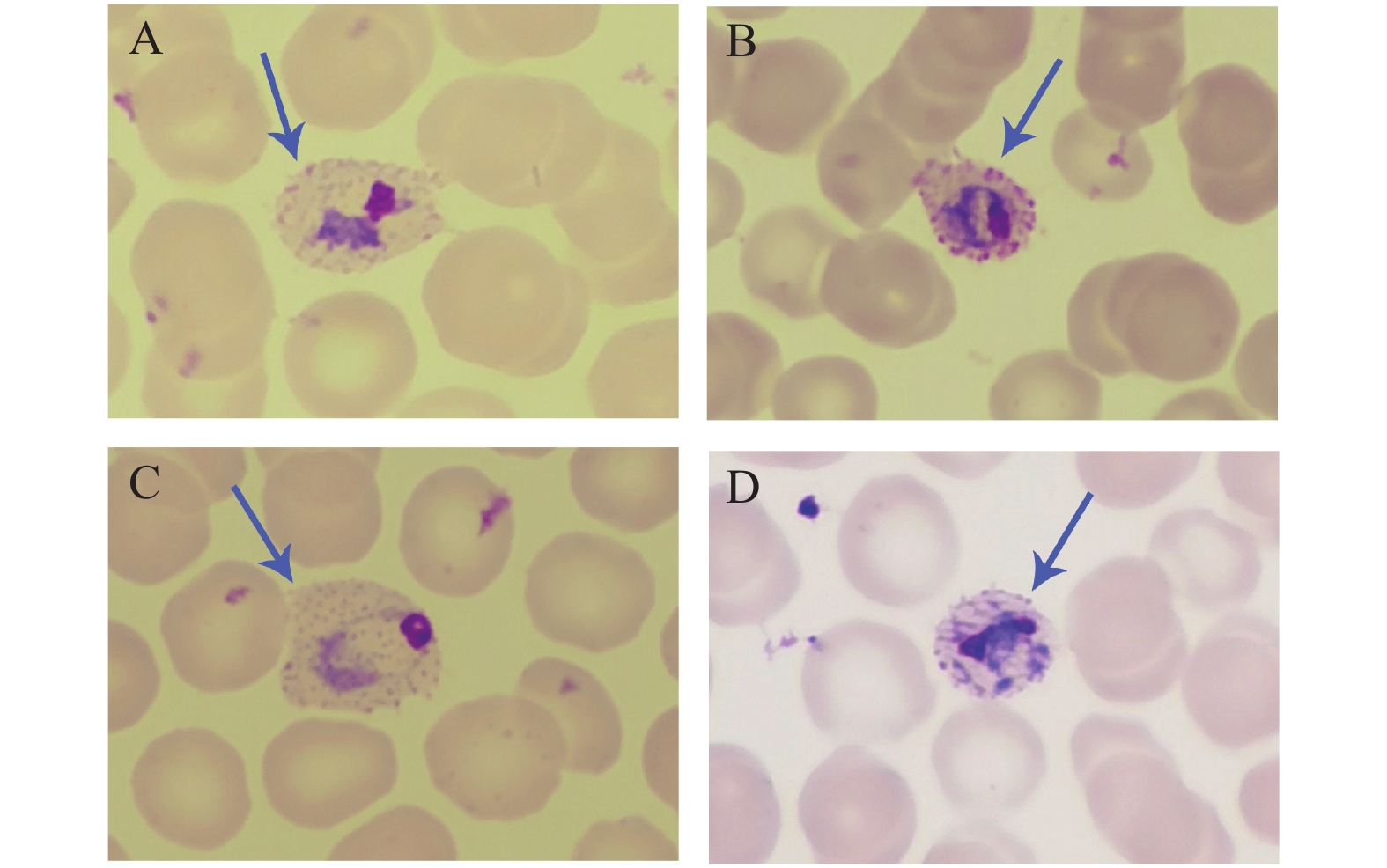 疟原虫血涂片