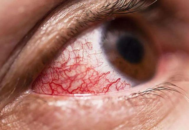 印度呼吁将毛霉菌病列为流行病,病死率是新冠的3倍|印度|新冠肺炎