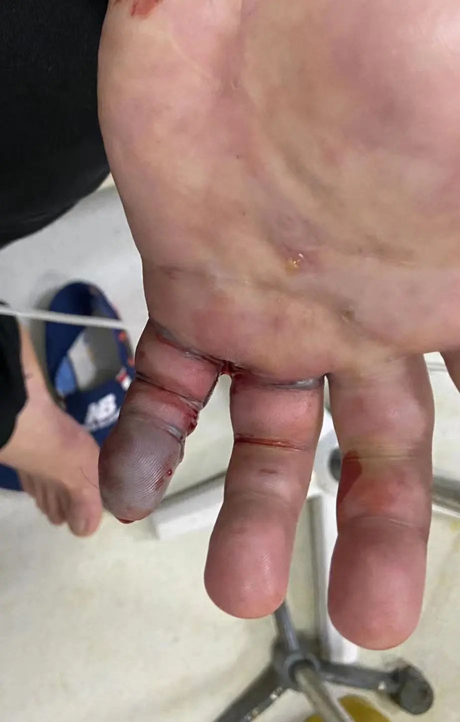 万万没想到桂林男子被海鱼扎伤手指左臂被截肢