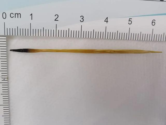 惊了男子经常肚子疼以为是肠胃不好结果取出65厘米长