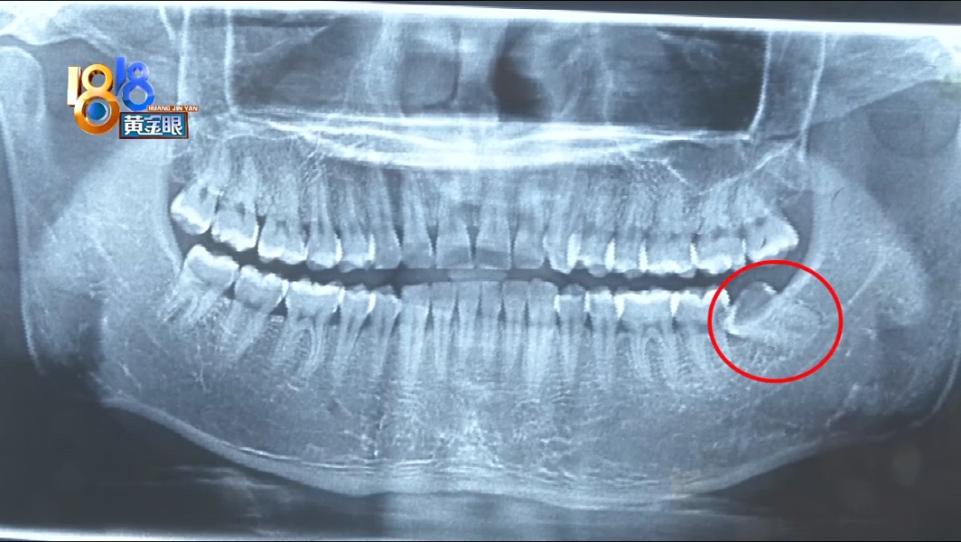 男子想拔左侧智齿却被拔了右边的医院给出不一样的解释