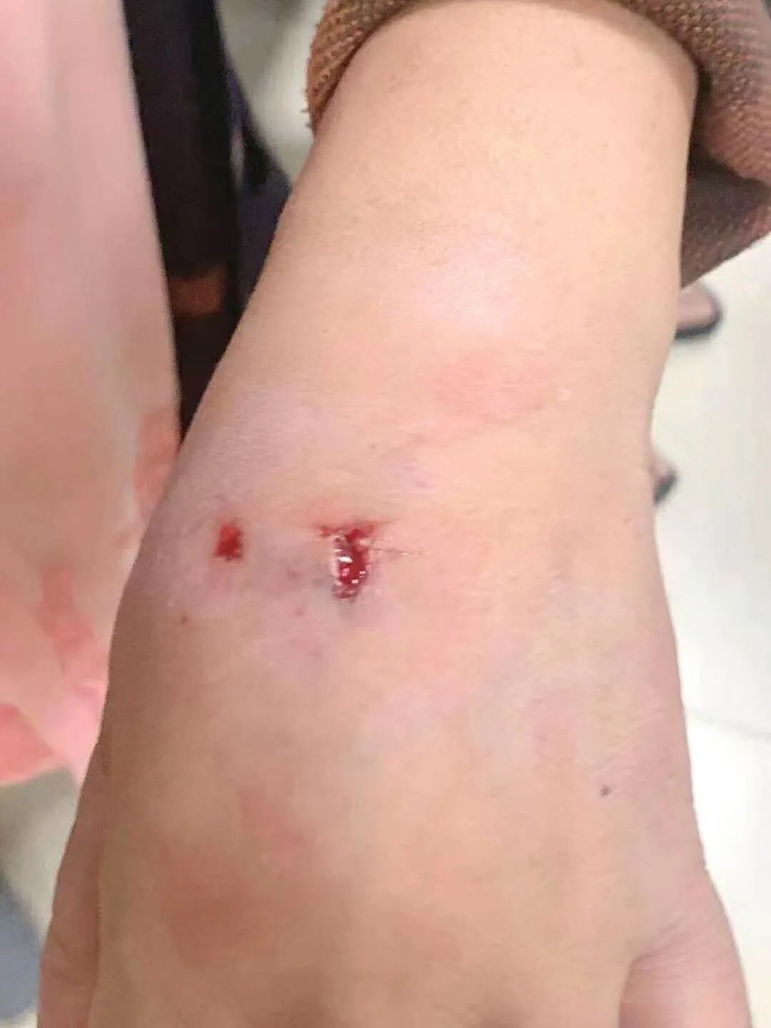 江苏南通一恶犬咬伤21人已被抓捕并送至流浪犬留检所