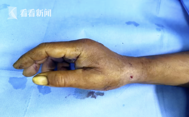 视频53岁大叔初学鱼镖射鱼第一发就扎穿了自己右手