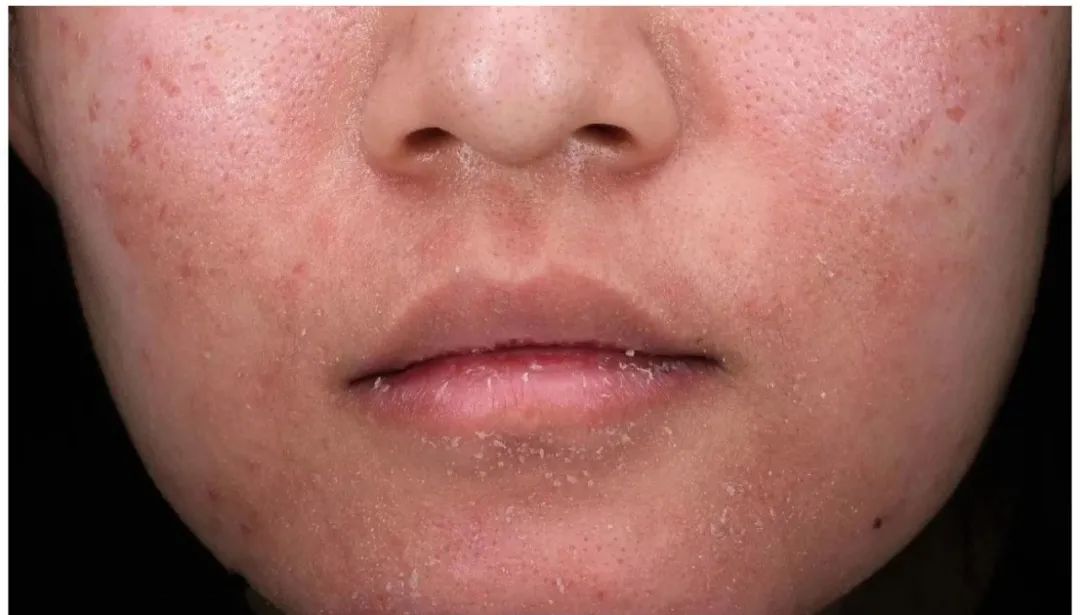 全国护肤日义诊| 解决皮肤敏感,衰老问题,报名即送一套敏感肌专用护肤