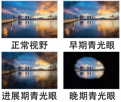 视野检查结果也多表现为旁中心暗点和鼻侧阶梯