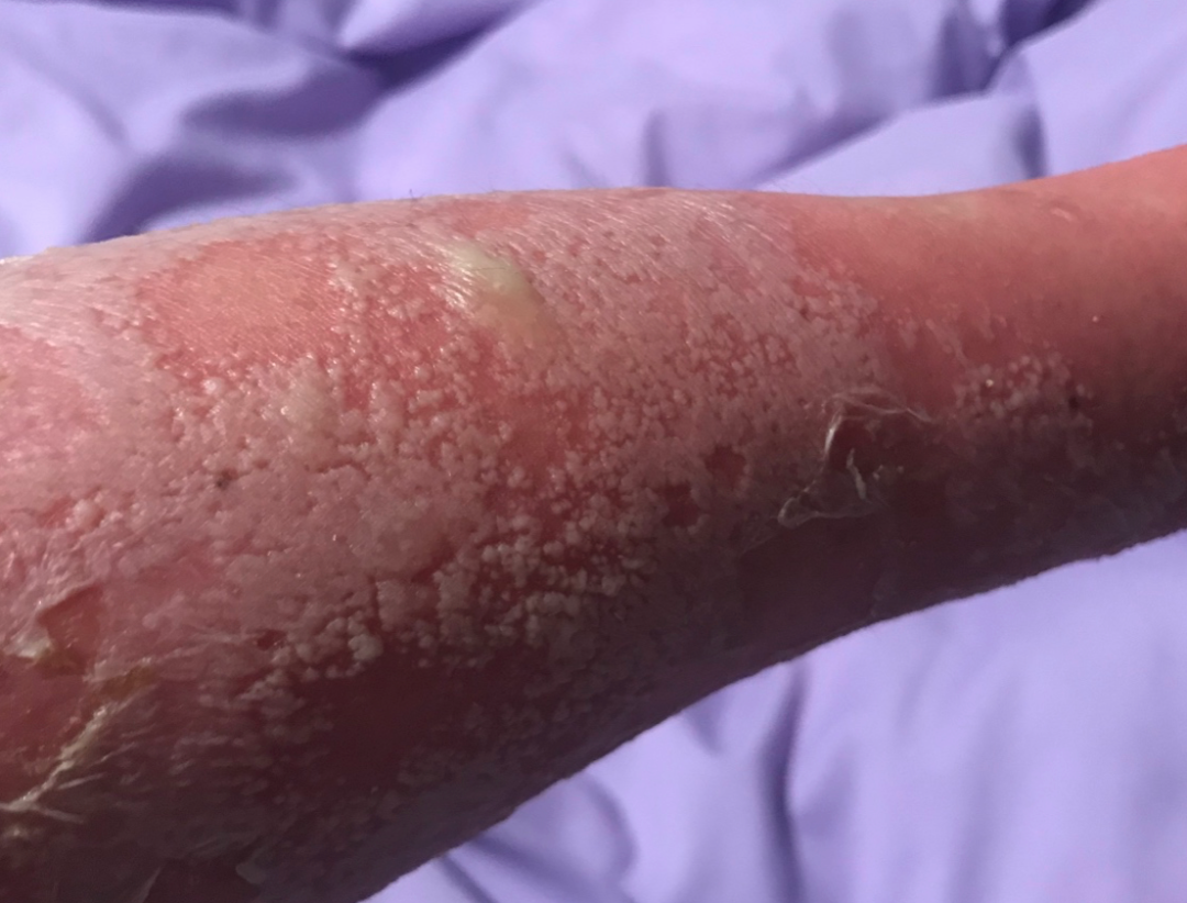 从星星点点的红疹发展到布满全身的厚厚的脓疱,我眼看着身上好的皮肤