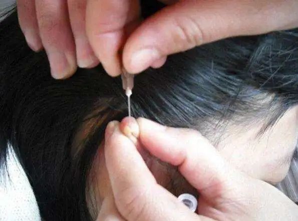 24种疑难杂症的刺血疗法这些疾病放一点点血就化解了