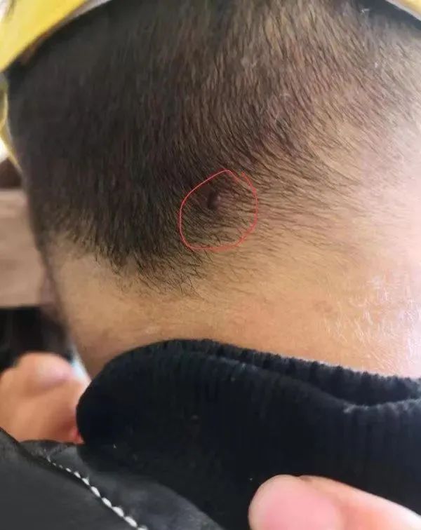 后脑勺疼一看有个黑点严重可致命
