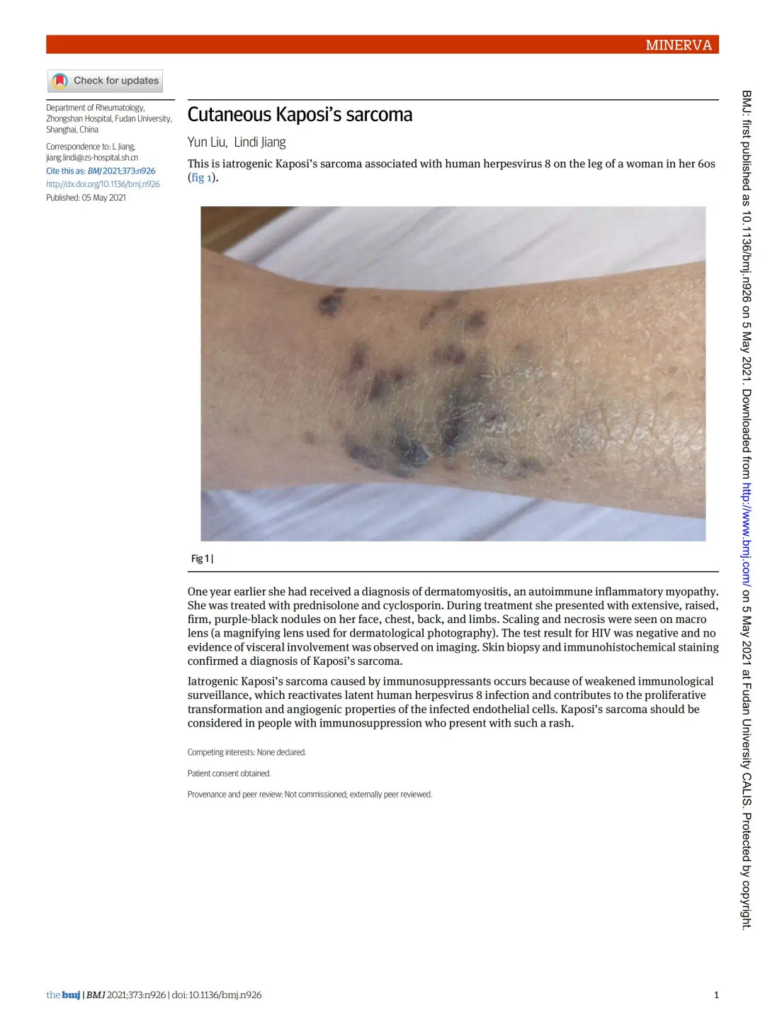 皮肌炎患者用药后全身多处出现紫黑色结节,上海医生查明病因|皮肌炎_