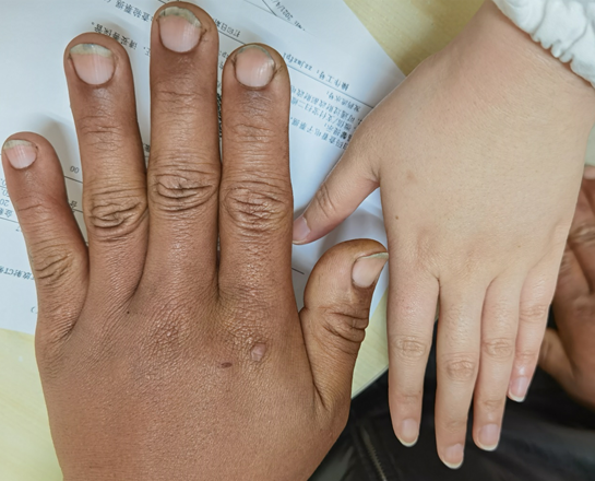 白发突增面容改变男子以为内分泌紊乱却被诊出肢端肥大症