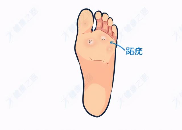 脚底长鸡眼挖了又长怎么办学会4招鸡眼不再是困扰