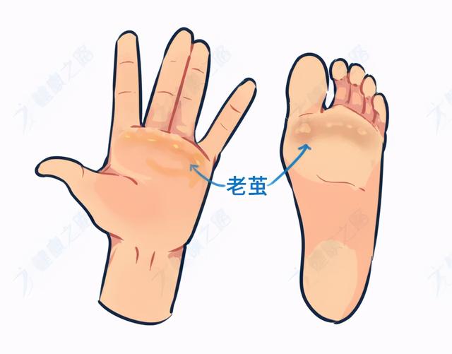 脚底长鸡眼挖了又长怎么办学会4招鸡眼不再是困扰