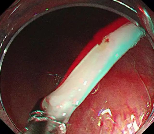 鱼刺,其中两角嵌顿食管入口,另一角嵌顿会咽部,陈医生使用异物钳钳住