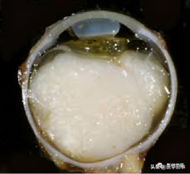 “白瞳症”:视网膜母细胞瘤（RB）影像学表现|视网膜_新浪新闻